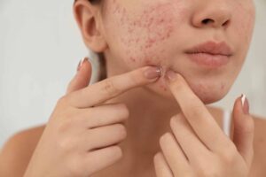 acne scar laser treatment with fractional co2 laser