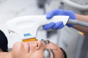 BBL laser for pigmentation redness and skin rejuvenation
