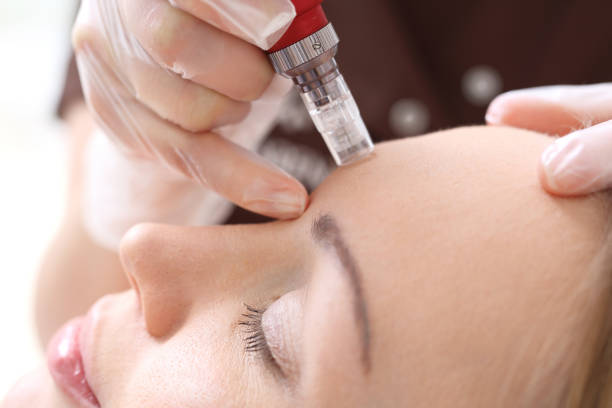 Dermapen microneedling treatment in Izmir for skin rejuvenation and acne scars by a dermatologist