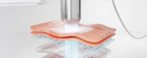 fractional co2 laser skin resurfacing treatment for acne scars and wrinkles