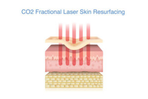 Fraksiyonel lazer uygulamasında karbondioksit (CO₂) lazerin erbium lazere göre cilt yenilemedeki farkı – İzmir dermatolog