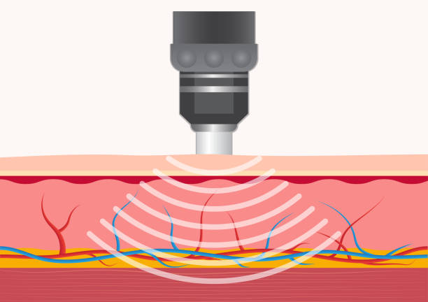 HIFU treatment in Izmir for non-surgical skin tightening and facial lifting by a dermatologist
