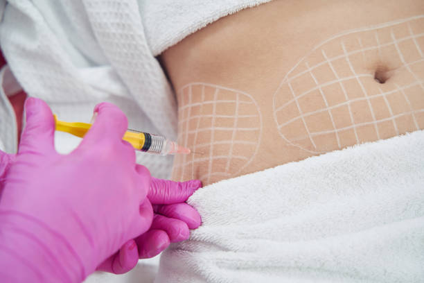 Injection lipolysis treatment in Izmir for localized fat reduction performed by a dermatologist