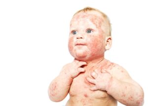 İzmir’de dermatolog tarafından uygulanan atopik dermatit tedavisi