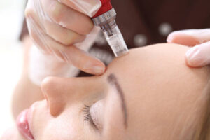 İzmir Dermapen uygulamaları ile cilt yenileme, kırışıklık ve leke tedavisi uzman dermatolog tarafından