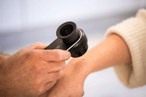 İzmir Displastik Ben Değerlendirmesi – Dermatolog