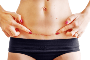 İzmir iz ve çatlak tedavisi lazer uygulamaları uzman dermatolog tarafından