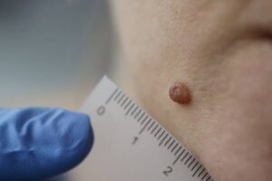 İzmir lazerle ben alma uygulamaları uzman dermatolog tarafından