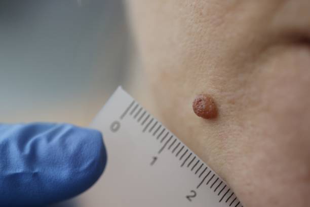 İzmir lazerle ben alma uygulamaları uzman dermatolog tarafından