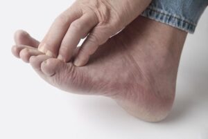 İzmir Mantar Hastalığı Tedavisi – Dermatolog
