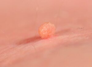 İzmir Siğil Tedavisi – Dermatolog
