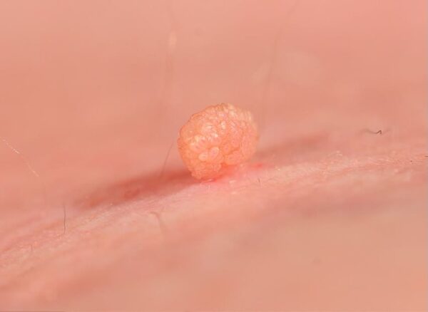 İzmir Siğil Tedavisi – Dermatolog