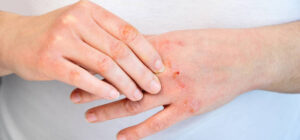 İzmir’de dermatolog tarafından uygulanan kontakt dermatit tedavisi