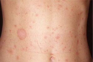 Pitiriyazis Rozea (Gül Hastalığı) – Dermatoloji