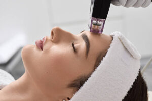 RF microneedling for collagen stimulation and skin tightening