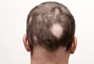 Dermatolog tarafından uygulanan saçkıran (alopecia areata) tedavisi
