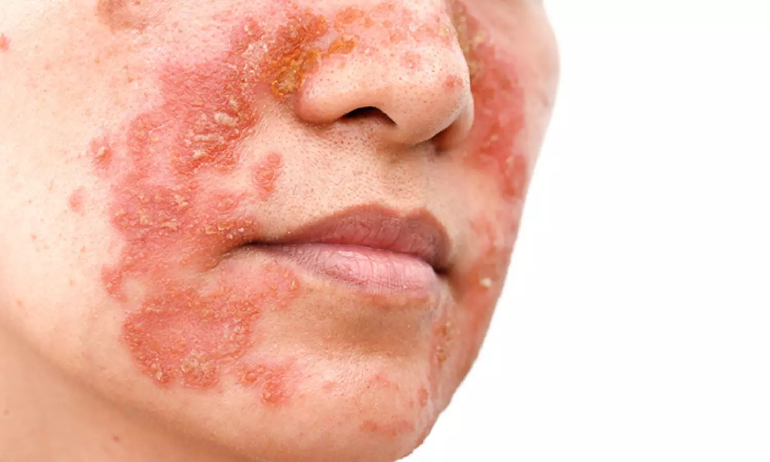 Seboreik Dermatit Tedavisi – Dermatolog