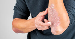 Dermatolog tarafından uygulanan sedef hastalığı (psoriasis) tedavisi