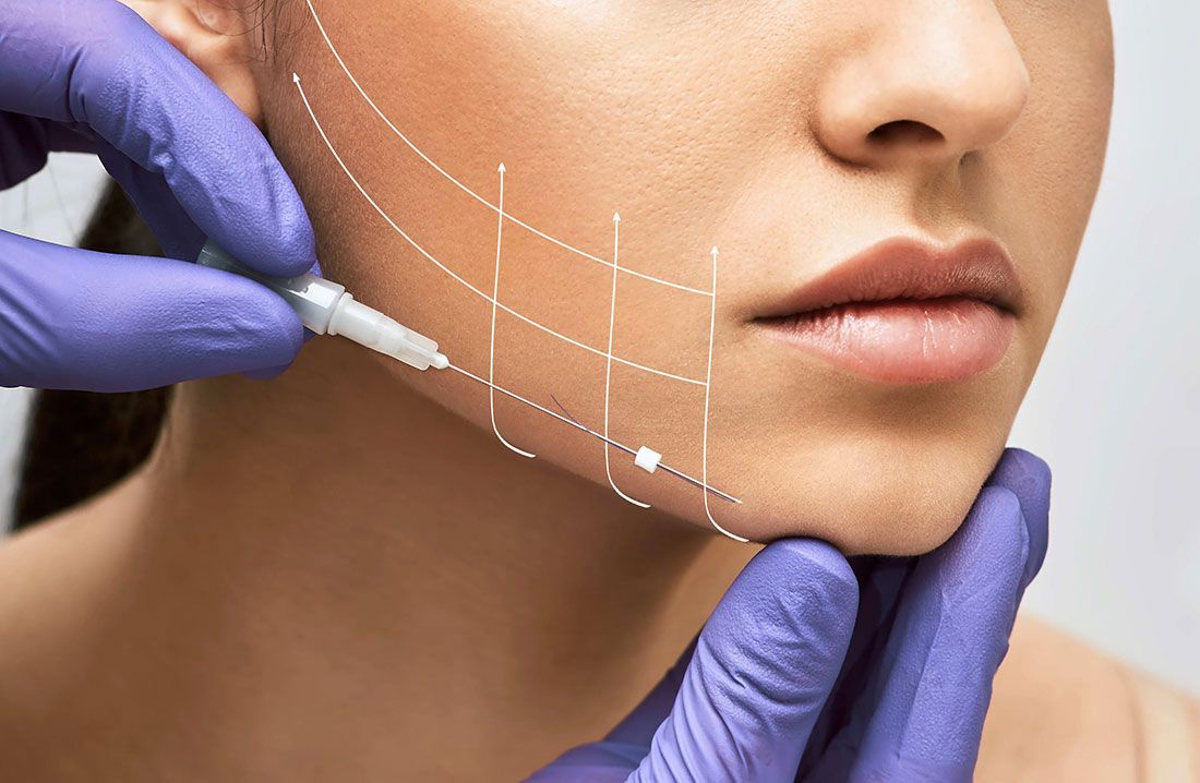 Thread lift treatment in Izmir for non-surgical facial lifting and skin tightening performed by a dermatologist