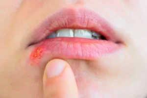 Uçuk (Herpes Simpleks) Tedavisi – Dermatolog