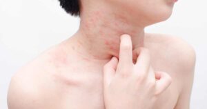 Ürtiker (Kurdeşen) Tedavisi – Dermatolog