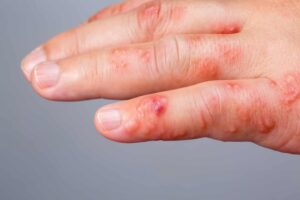 Dermatolog tarafından uygulanan uyuz hastalığı (scabies) tedavisi