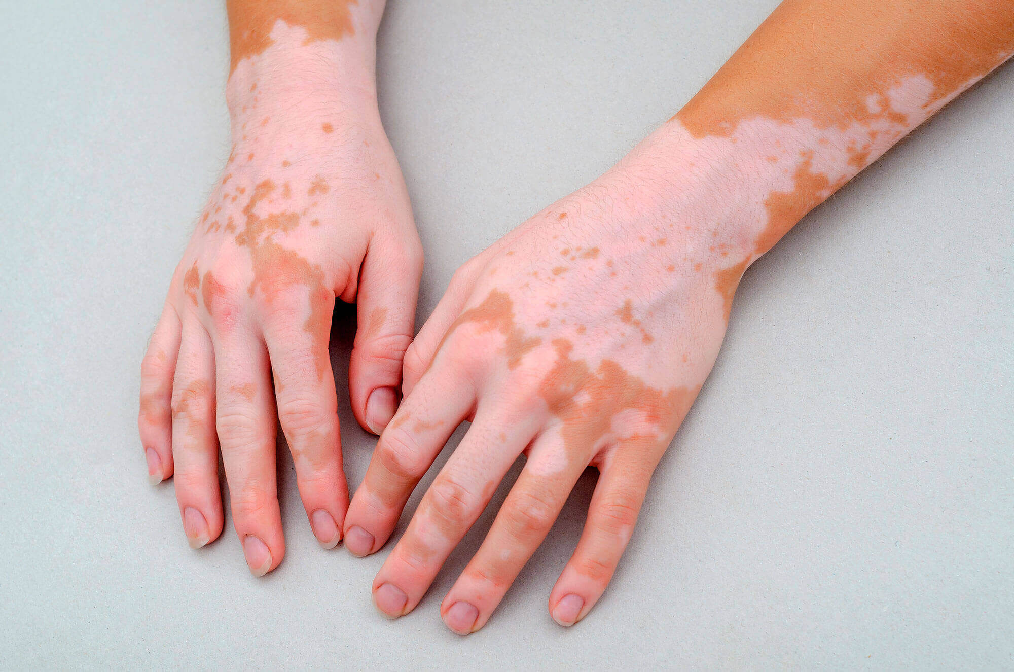 Vitiligo Tedavisi – Dermatolog
