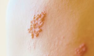 Zona Tedavisi – Dermatolog